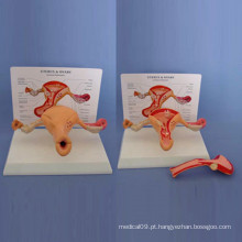 Modelo de anatomia do útero mórbido feminino para o ensino médico (R110201)
